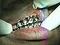 Throwback Footage Of The Week: Birdman Showing How To Get 100K Platinum Grill Drilled In By Dentist!