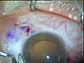 Pterygium excision and conjunctival autograft