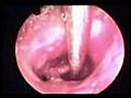 Perforated Tympanic Membrane