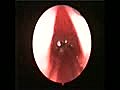 Endoscopic View of Vocal cords