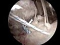 Rotator Cuff Repair