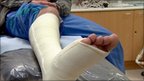 VIDEO: Could this be the end of plaster casts?