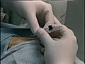 Radial Artery Catheterization