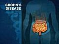 Natural Healing For Crohn’s Disease