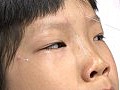 中大研究：針灸比戴眼鏡更有效治療兒童弱視