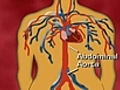 Aortic Aneurysms