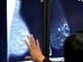 Digital Mammography Can Help Detect Breast Cancer Earlier