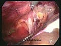 Hernia Repair Transabdominal Preperitoneal Inguina