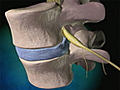 Information on Degenerative Disc Replacement Surgery