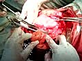 Recurrent Myoma Part 1