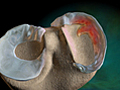 Medial Meniscus Injury and Surgery