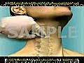 3D Medical Animation: Anterior Cervical Fusion