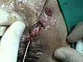 Fistulotomy Surgery