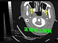 鼻のＣＴ検査の一般的な結果について
