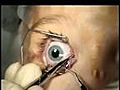 Strabismus Surgery