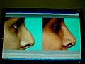 RHINOPLASTY  IN QATAR