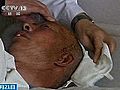Bullet Removed From Man’s Head After 23 Years.
