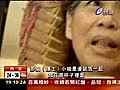 護士餵藥未撕鋁箔婦人卡喉咳血