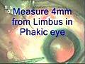 Intravitreal Injection Avastin In WET AMD