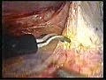 Laparoscopic Hysterectomy