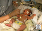 EXIT procedure saves babies&#039; lives