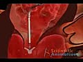 Heart Valve Surgery Animation