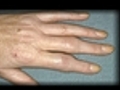 Treating Rheumatoid Arthritis