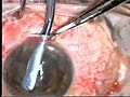 Keratoplastik