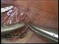 Laparoscopic Hiatus Hernia Repair