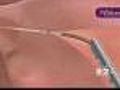 HealthWatch: Permanent Birth Control In Minutes
