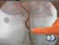 New Option For Clogged Carotid Artery