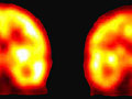 Chirurgia per l’epilessia