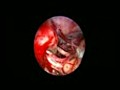 Endoscopic View of the Trigeminal Nerve