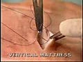 Vetical Mattress Suture