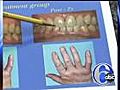 Link between gum disease and arthritis