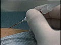 Radial Artery Catheterization