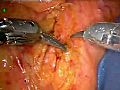 Robotic Surgery Endometriumkarzinom