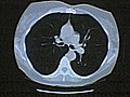 Early CT Scans Cut Lung Cancer Death Rate