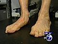 Treatment for aging flat feet