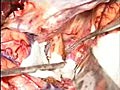 Linke A. communicans anterior-Aneurysma