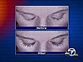 FDA approves eyelash-growing drug