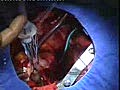 Mitral Valve Replacement Surgery