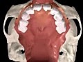 Cleft Palate