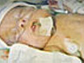 Premature Baby&#039;s Right To Life?