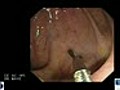 Colon - Chromoendoscopy during Ulcerative Colitis Surveillance