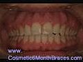 Cosmetic 6 month braces - Cosmetic Dentist Bruce Bilow