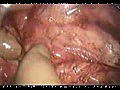 Laparoscopic Nephrectomy