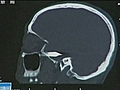 Bullet lodged in man’s brain