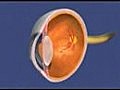 Retinopathy of Prematurity (ROP)