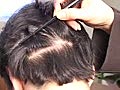 Hair Transplant Closeup: Trichophytic Closure,  Ear